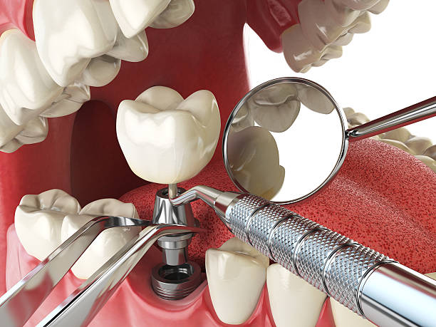 Best Emergency Dental Extractions in New Athens, IL